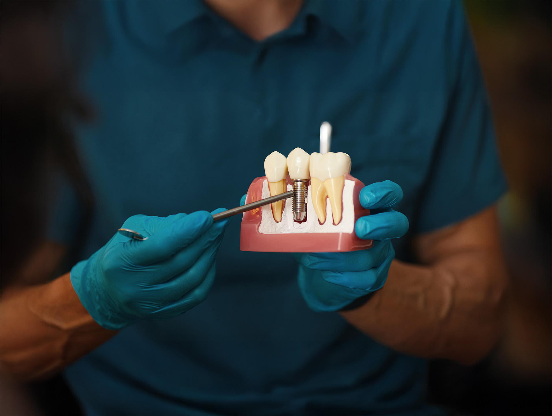 Dental Implants