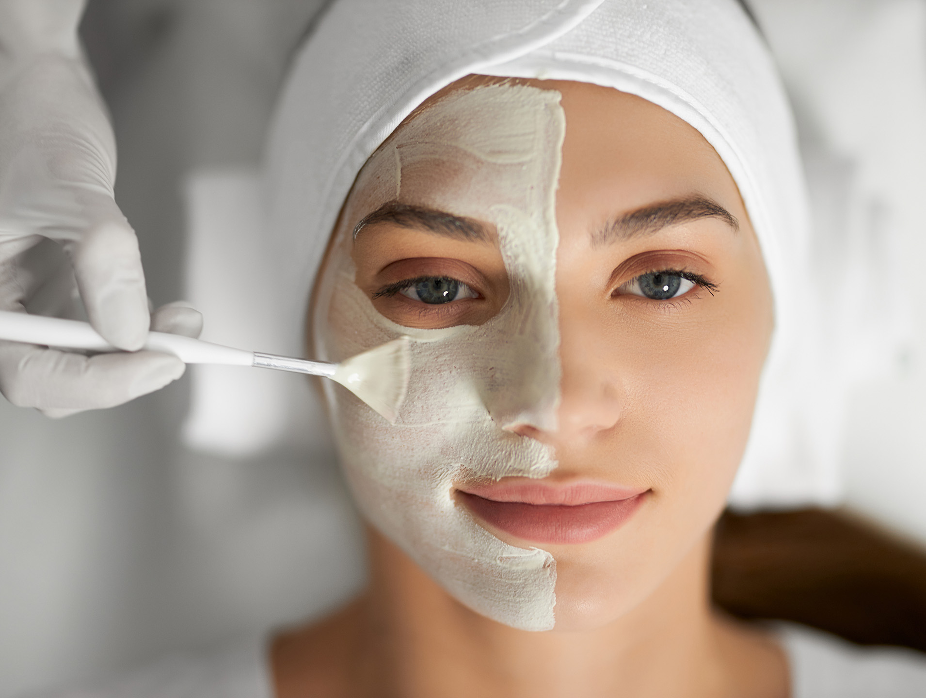 Chemical Peels